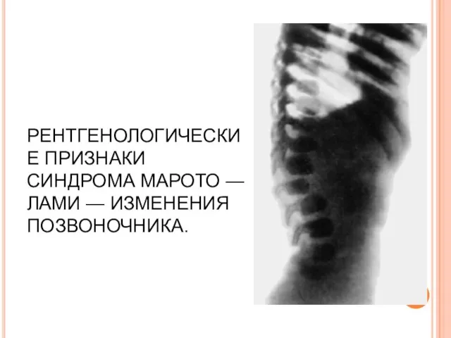 РЕНТГЕНОЛОГИЧЕСКИЕ ПРИЗНАКИ СИНДРОМА МАРОТО — ЛАМИ — ИЗМЕНЕНИЯ ПОЗВОНОЧНИКА.