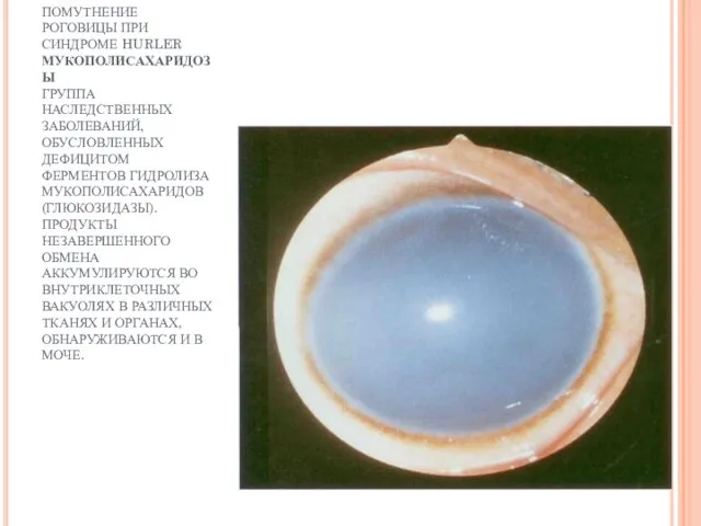 ПОМУТНЕНИЕ РОГОВИЦЫ ПРИ СИНДРОМЕ HURLER МУКОПОЛИСАХАРИДОЗЫ ГРУППА НАСЛЕДСТВЕННЫХ ЗАБОЛЕВАНИЙ, ОБУСЛОВЛЕННЫХ ДЕФИЦИТОМ