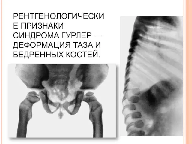 РЕНТГЕНОЛОГИЧЕСКИЕ ПРИЗНАКИ СИНДРОМА ГУРЛЕР — ДЕФОРМАЦИЯ ТАЗА И БЕДРЕННЫХ КОСТЕЙ.