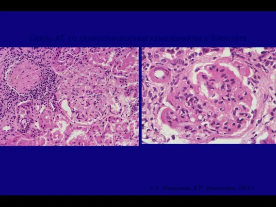 Связь АГ со склеротическими изменениями в биоптате почки С.А. Мартынов, Б.Р. Джаналиев, 2003 г.