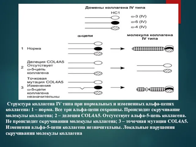 Структура коллагена IV типа при нормальных и измененных альфа-цепях коллагена: 1