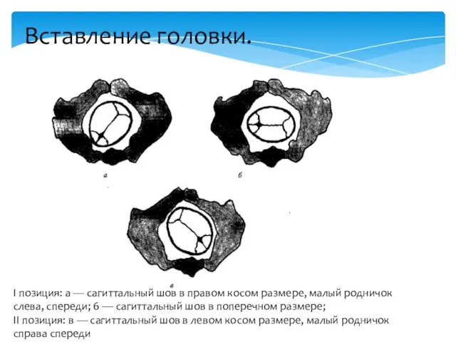 Вставление головки. I позиция: а — сагиттальный шов в правом косом