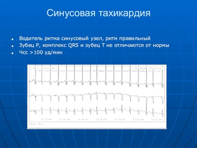 Синусовая тахикардия Водитель ритма синусовый узел, ритм правильный Зубец Р, комплекс