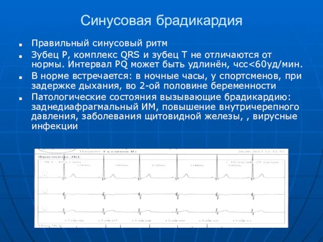 Синусовая брадикардия Правильный синусовый ритм Зубец Р, комплекс QRS и зубец