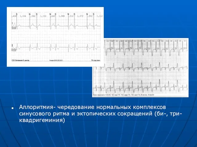 Аллоритмия- чередование нормальных комплексов синусового ритма и эктопических сокращений (би-, три-квадригеминия)