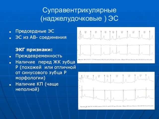 Суправентрикулярные (наджелудочковые ) ЭС Предсердные ЭС ЭС из АВ- соединения ЭКГ