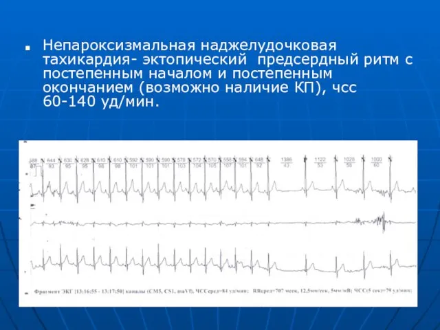 Непароксизмальная наджелудочковая тахикардия- эктопический предсердный ритм с постепенным началом и постепенным