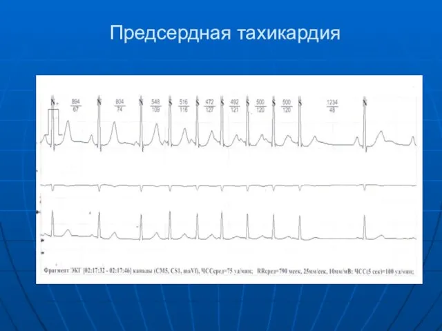 Предсердная тахикардия