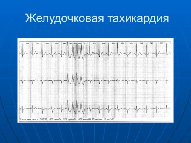 Желудочковая тахикардия