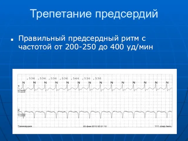 Трепетание предсердий Правильный предсердный ритм с частотой от 200-250 до 400 уд/мин