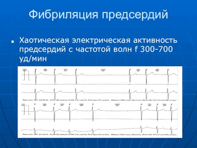 Фибриляция предсердий Хаотическая электрическая активность предсердий с частотой волн f 300-700 уд/мин