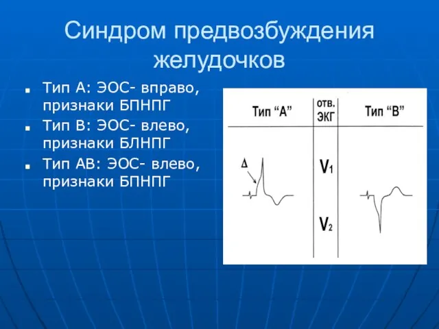 Синдром предвозбуждения желудочков Тип А: ЭОС- вправо, признаки БПНПГ Тип В: