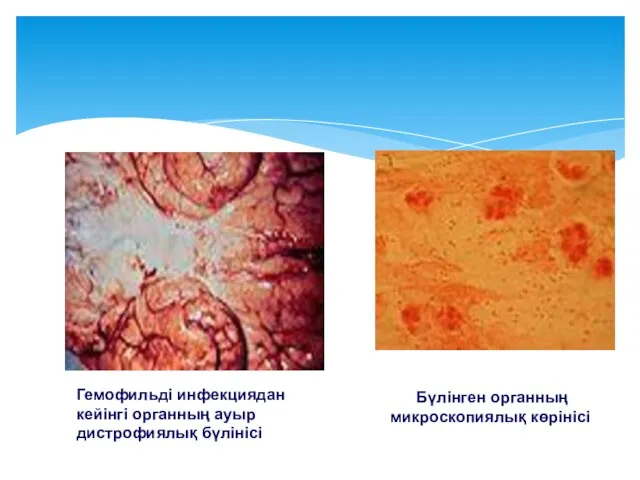 Гемофильді инфекциядан кейінгі органның ауыр дистрофиялық бүлінісі Бүлінген органның микроскопиялық көрінісі