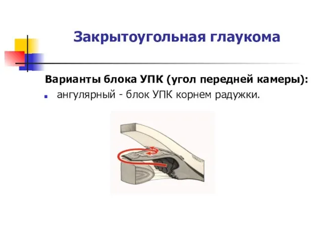Закрытоугольная глаукома Варианты блока УПК (угол передней камеры): ангулярный - блок УПК корнем радужки.