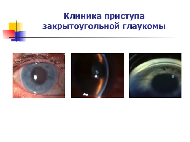 Клиника приступа закрытоугольной глаукомы