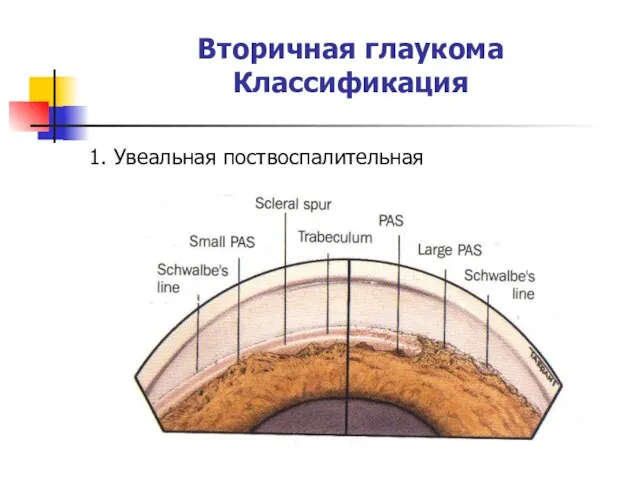 Вторичная глаукома Классификация 1. Увеальная поствоспалительная