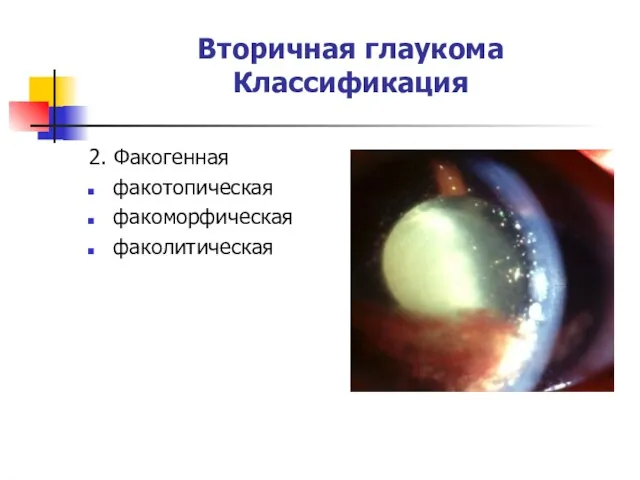 Вторичная глаукома Классификация 2. Факогенная факотопическая факоморфическая факолитическая