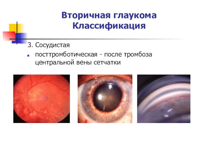 Вторичная глаукома Классификация 3. Сосудистая посттромботическая - после тромбоза центральной вены сетчатки