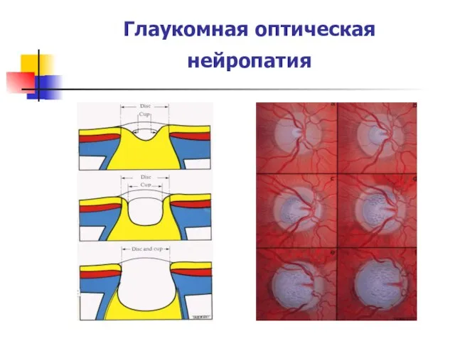 Глаукомная оптическая нейропатия