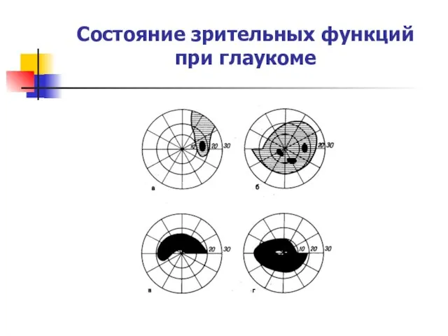 Состояние зрительных функций при глаукоме