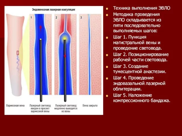 Техника выполнения ЭВЛО Методика проведения ЭВЛО складывается из пяти последовательно выполняемых