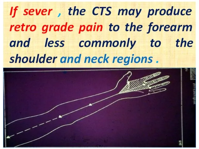 If sever , the CTS may produce retro grade pain to