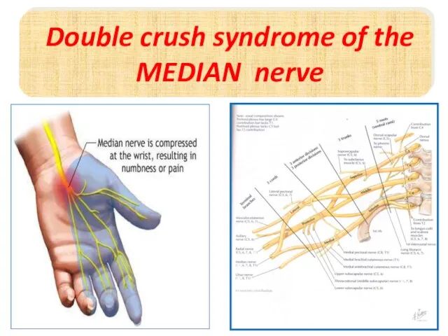 Double crush syndrome of the MEDIAN nerve