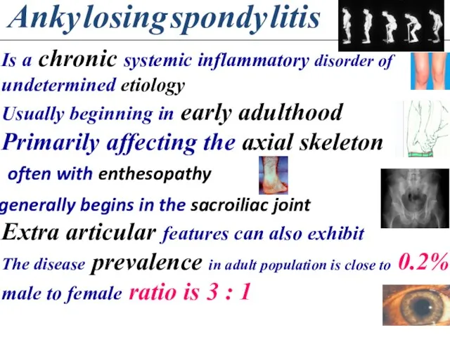 Anky losing spondy litis Is a chronic systemic inflammatory disorder of