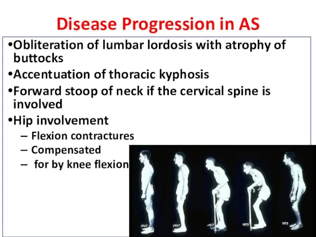 Disease Progression in AS Obliteration of lumbar lordosis with atrophy of