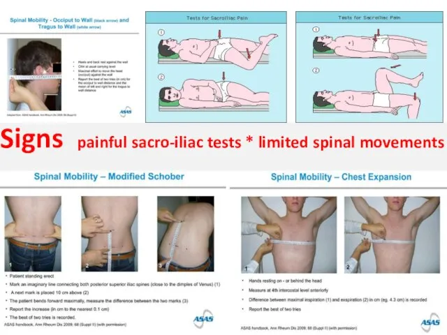 Signs painful sacro-iliac tests * limited spinal movements