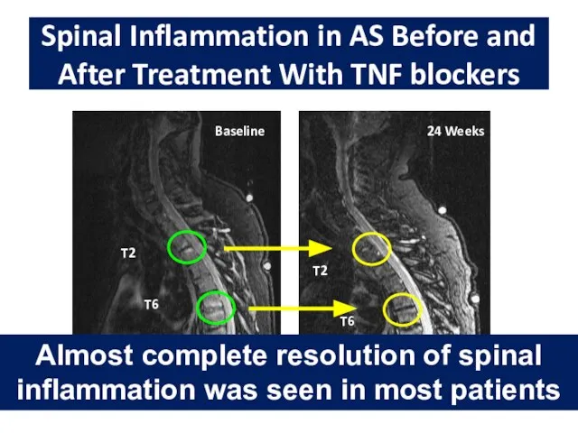 Spinal Inflammation in AS Before and After Treatment With TNF blockers