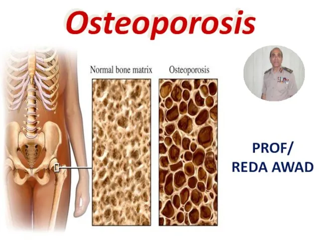 Osteoporosis PROF/ REDA AWAD