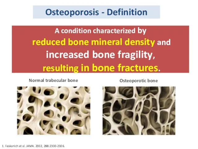 A condition characterized by reduced bone mineral density and increased bone