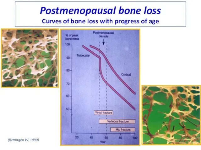 Postmenopausal bone loss Curves of bone loss with progress of age (Remagen W, 1990)