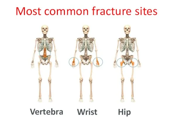 Most common fracture sites Vertebra Wrist Hip