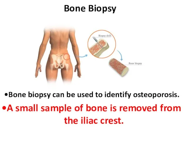 Bone Biopsy Bone biopsy can be used to identify osteoporosis. A