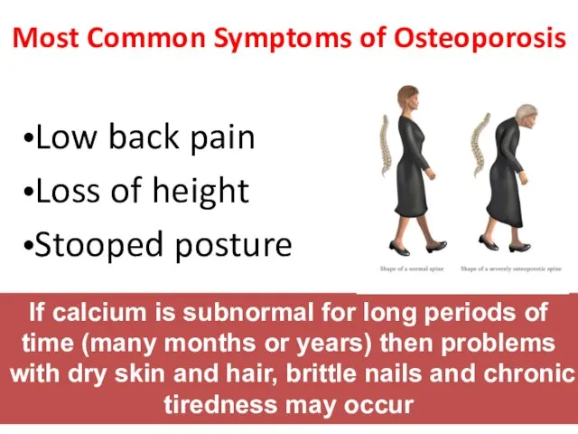 Most Common Symptoms of Osteoporosis Low back pain Loss of height