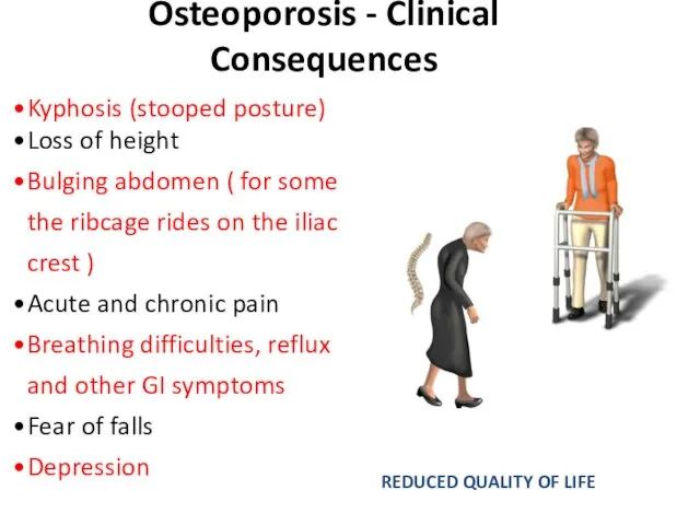 Osteoporosis - Clinical Consequences Kyphosis (stooped posture) Loss of height Bulging