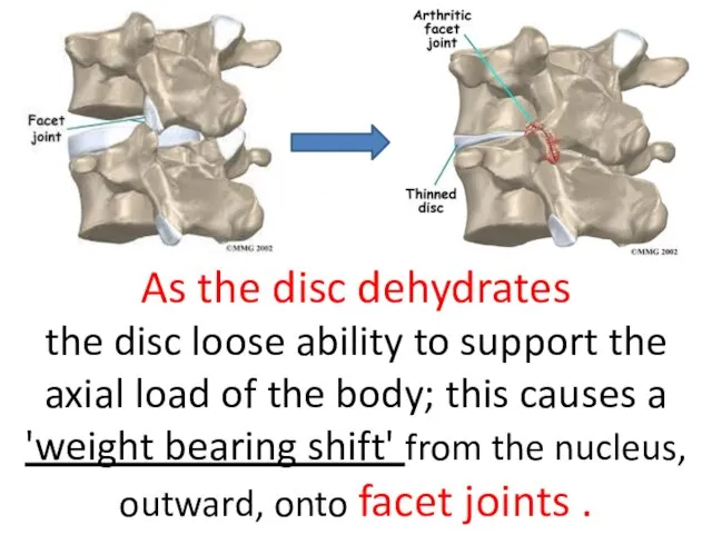 As the disc dehydrates the disc loose ability to support the