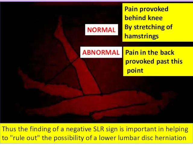 Pain provoked behind knee By stretching of hamstrings Pain in the