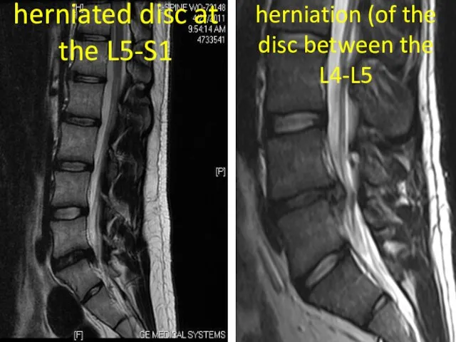 herniated disc at the L5-S1 herniation (of the disc between the L4-L5