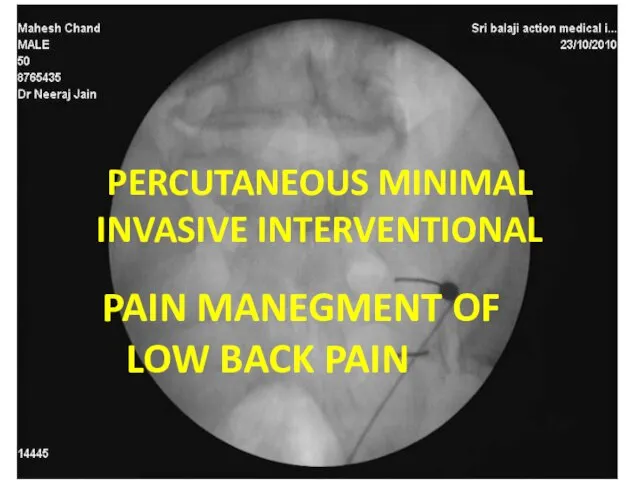 PERCUTANEOUS MINIMAL INVASIVE INTERVENTIONAL PAIN MANEGMENT OF LOW BACK PAIN