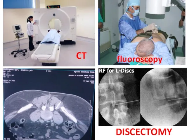 fluoroscopy CT DISCECTOMY