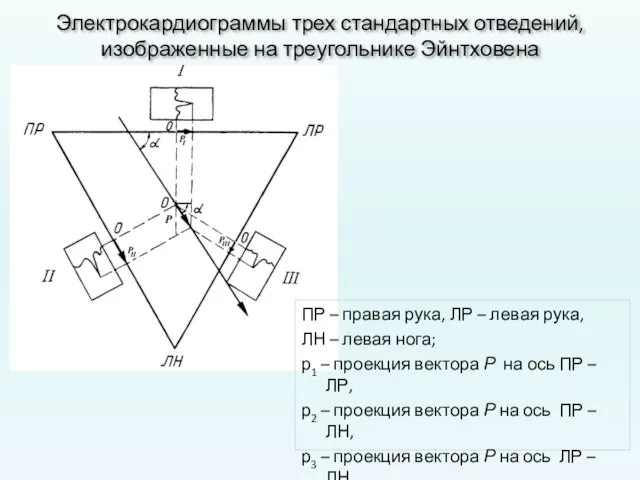 Электрокардиограммы трех стандартных отведений, изображенные на треугольнике Эйнтховена ПР – правая