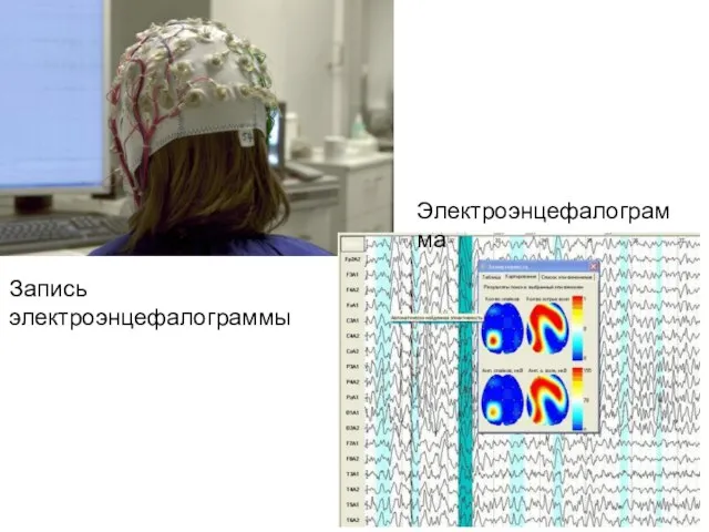 Электроэнцефалограмма Запись электроэнцефалограммы