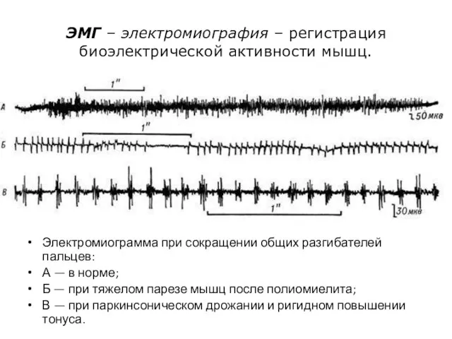 ЭМГ – электромиография – регистрация биоэлектрической активности мышц. Электромиограмма при сокращении