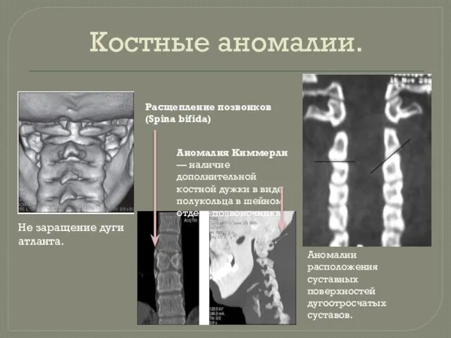 Костные аномалии. Аномалии расположения суставных поверхностей дугоотросчатых суставов. Не заращение дуги