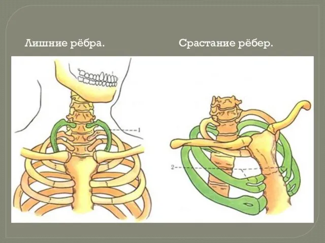 Лишние рёбра. Срастание рёбер.