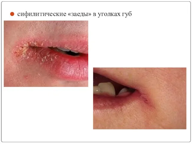 сифилитические «заеды» в уголках губ