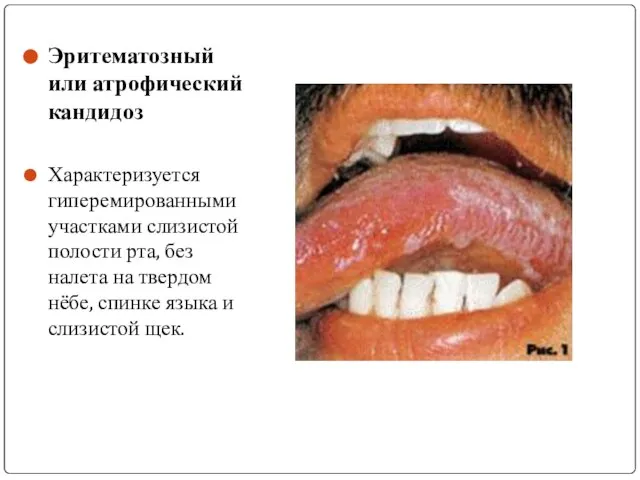 Эритематозный или атрофический кандидоз Характеризуется гиперемированными участками слизистой полости рта, без